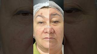 #botoxfullface #botox #морщины #ботокс #межбровка #диспорт #брыли #носогубка #косметолог #лифтинг