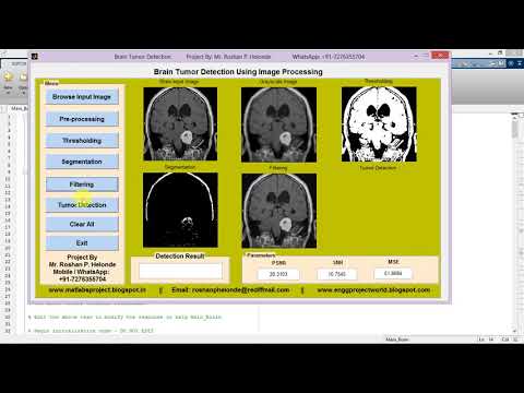 Matlab Code for Brain Tumor Detection Using Image Processing