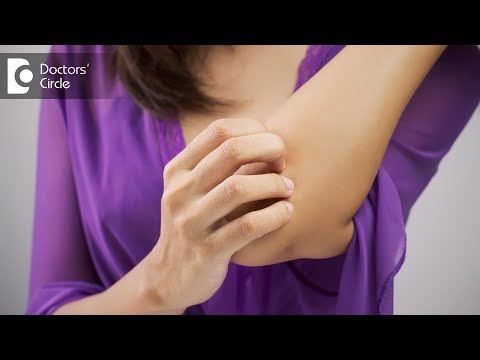 Video: Mosquito Bite Blisters: Wat Veroorzaakt Ze En Hoe Ze Te Behandelen