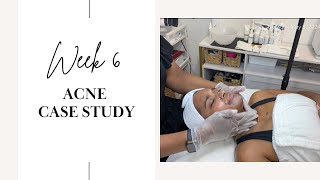 Famous Acne Case Study - Week 6 Profile