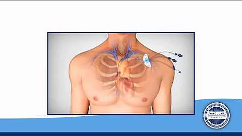 ARROW® Vascular Academy-Central Venous Access