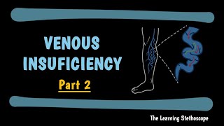 Venous Insufficiency — Part 2: Diagnosis and Treatment