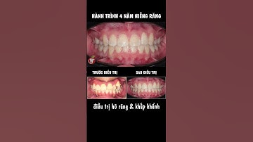 Hành trình 4 năm niềng răng hô & khấp khểnh | #shorts