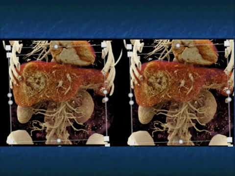 CT and CTA Evaluation of Hepatoma Part 1