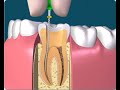 Live case root canal glide path