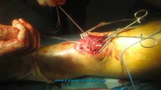 Anatomia rodilla tendones de
