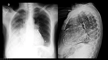 Quanto dura il dolore da pericardite?