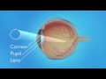 Detached Retina: Pneumatic Retinopexy