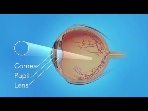 Detached Retina: Pneumatic Retinopexy