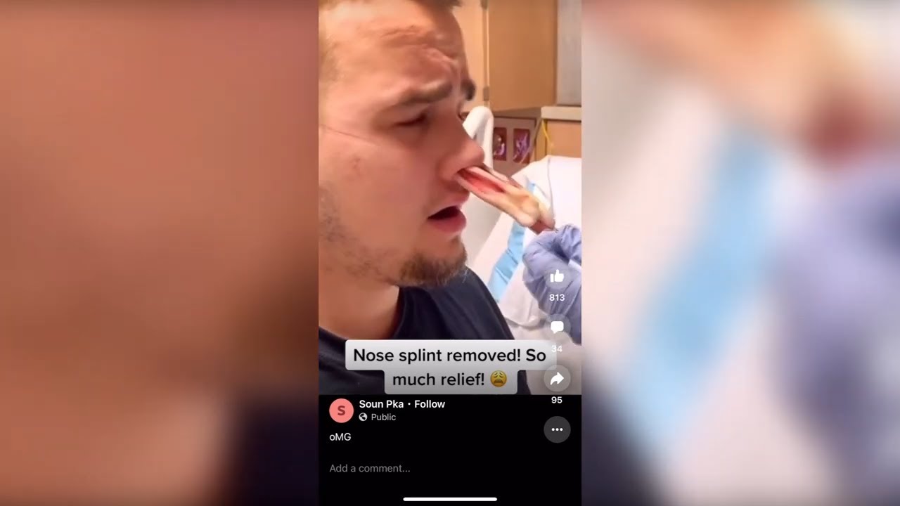Popping huge blackheads and Pimple Popping - Best Pimple Popping Videos #58
