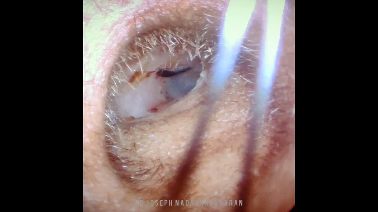 Bug in ear 👂 - YouTube