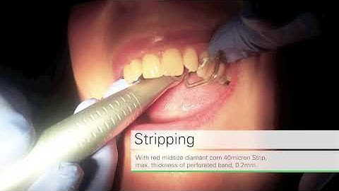 oscident IPR treatment