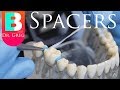 [BRACES EXPLAINED] Spacers