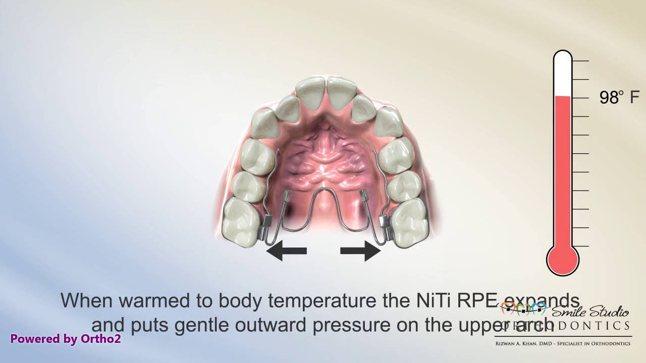 NiTi Palatal Expander Orthodontics YouTube