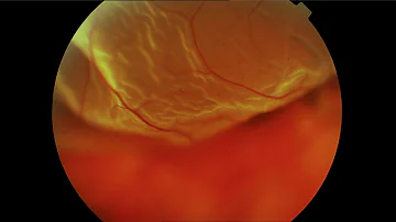 ¿Qué aspecto tienen las moscas volantes del desprendimiento de retina?