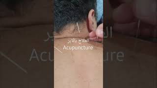 العلاج بالابر #acupuncture