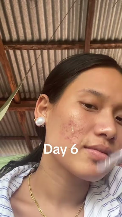 7days result of skin1004 brightening ampoule @SKINKorea