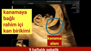 9 haftalık gebelik subkoryonik hematom (kanama alanı) ultrason görünümü, bebek sağlıklı ve hareketli