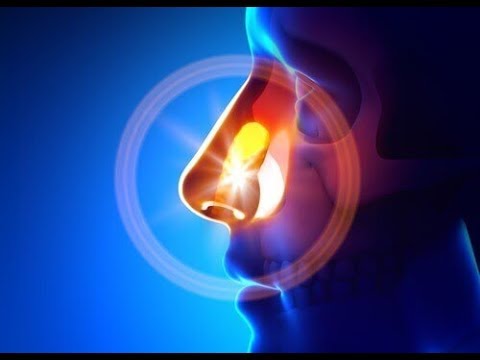 Video: Hoe om nasosinusitis te behandel?
