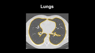 How to identify normal lung anatomy on chest CT