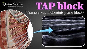 Ultrasound Guided Transversus Abdominis Plane (TAP) Block