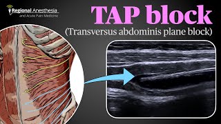 Ultrasound Guided Transversus Abdominis Plane (TAP) Block