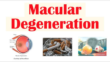 Macular Degeneration | Wet vs Dry | Risk Factors, Pathophysiology, Symptoms, Diagnosis, Treatment