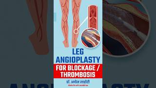 Opening Blocked Arteries Of Legs With Balloon Angioplasty