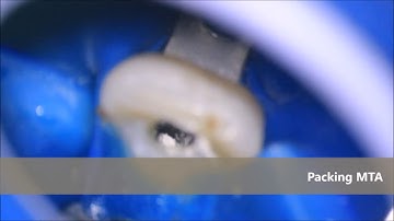 MTA placement in Upper cental incisors Open apex cases