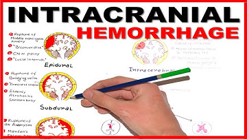 Intracranial Hemorrhage- Epidural/Subdural/Subarachnoid overview