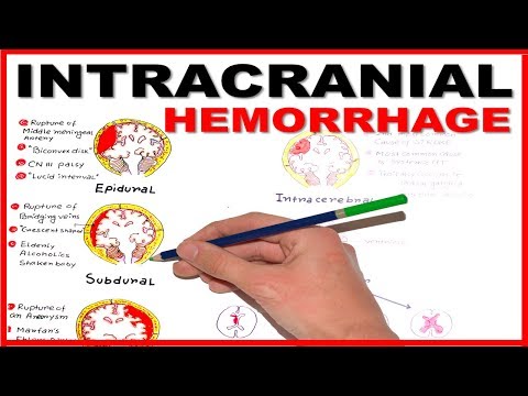 Intracranial Hemorrhage- Epidural/Subdural/Subarachnoid overview