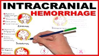 Intracranial Hemorrhage- Epidural/Subdural/Subarachnoid overview screenshot 1