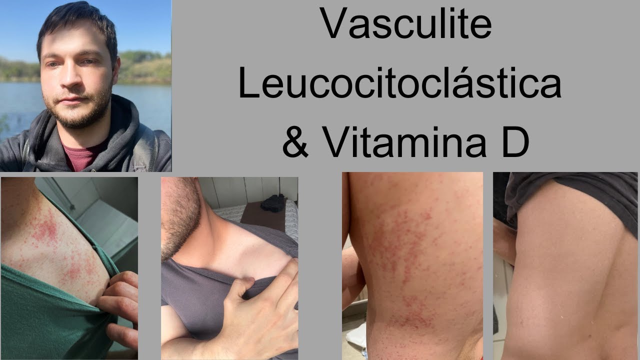Tadeu - Vasculite Leucocitoclástica (Púrpura Palpável) #1064