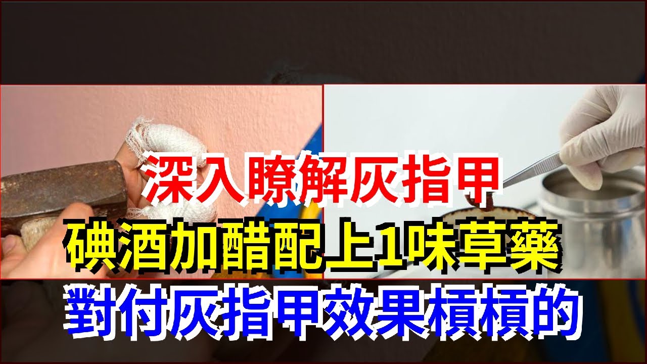 深入瞭解灰指甲 碘酒加醋配上1味草藥 對付灰指甲效果槓槓的 Youtube 深入瞭解灰指甲 碘酒加醋配上1味草藥 對付灰指甲效果槓槓的 Youtube