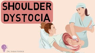 Shoulder Dystocia