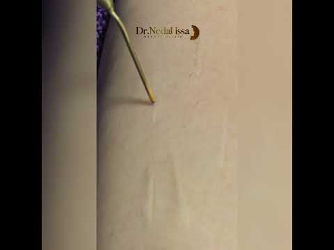 معالجة الندبات بالبلازما جت الألماني الأصلي دون نقط سوداء أو حفر فقط إحمرار يزول سريعا 0933233301