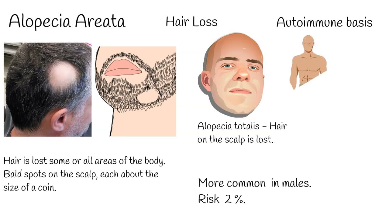 Hair Loss (Alopecia Areata)Treatment * NEW* FDA Approved New drug