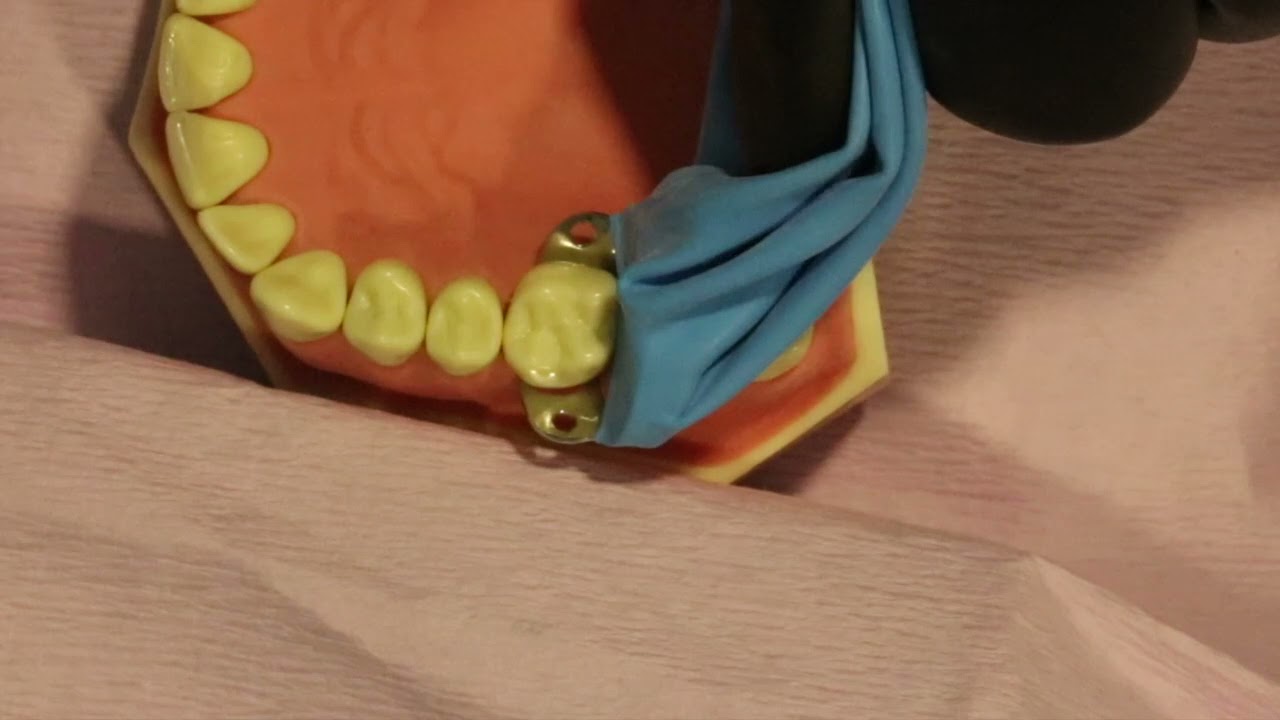 digue unitaire méthode parachute