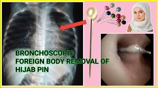 Lung Foreign Body Removal of Hijab Pin at SQUARE HOSPITAL LTD Dhaka Bangladesh #BD_ENDOSCOPY