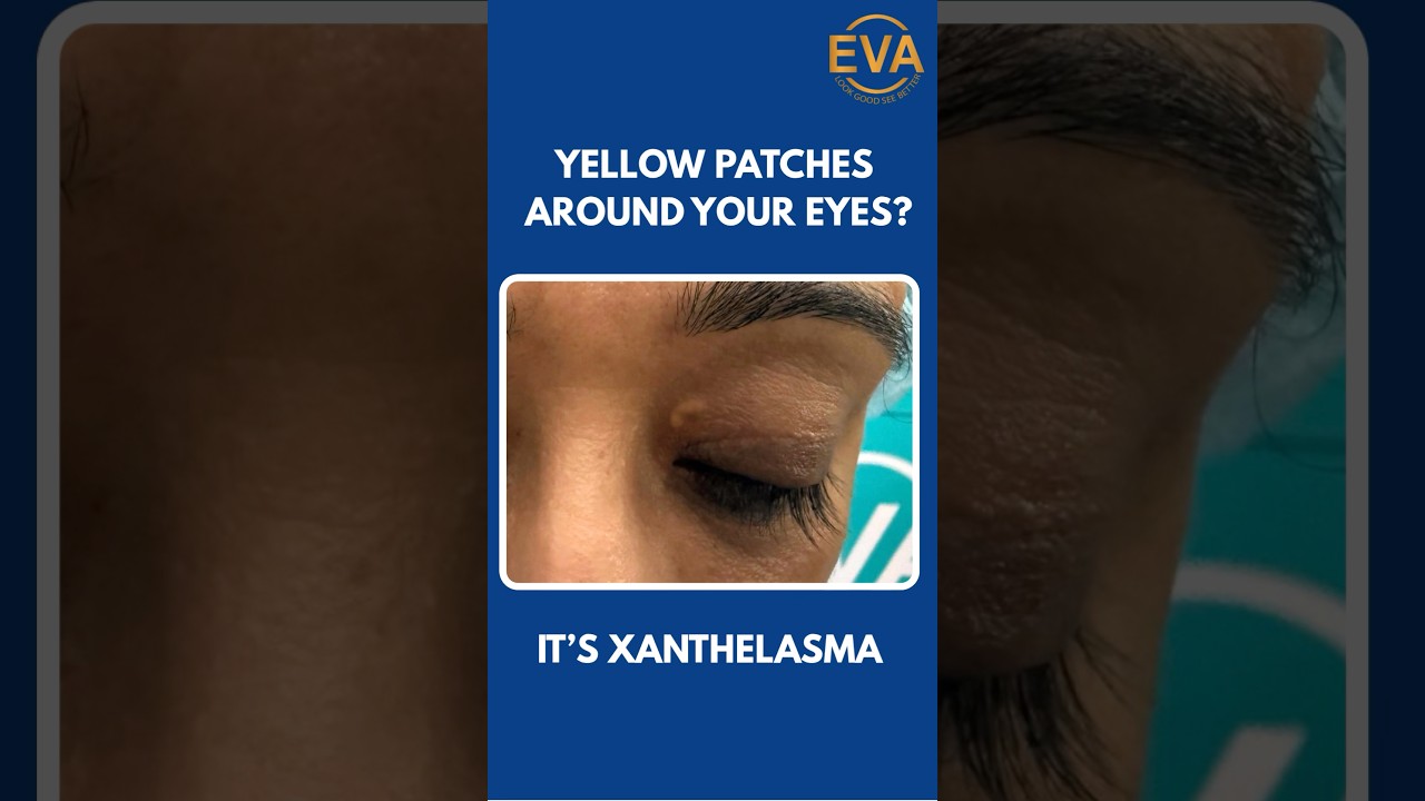 Fat pads around eyes#xanthelasma #eyelidsurgery #drhiranmayijha #cosmeticsurgery #eternaaesthetics