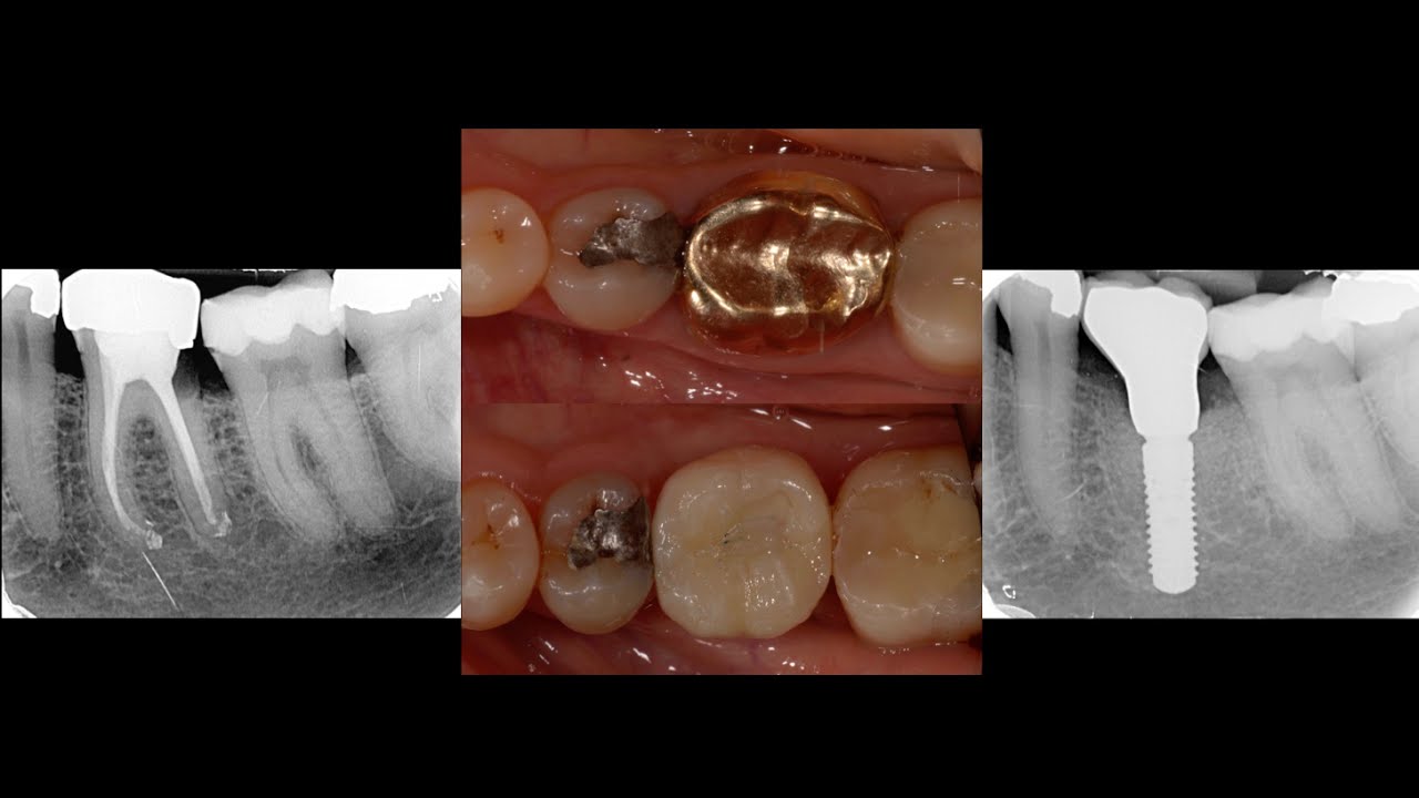 Surgical Extraction & Immediate Dental Implant Placement Lower Left