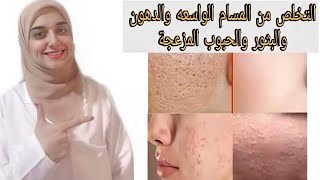 اسهل طريقه لمنع الحبوب والبثور والتخلص من المسام الواسعه و الحصول على بشره صافية