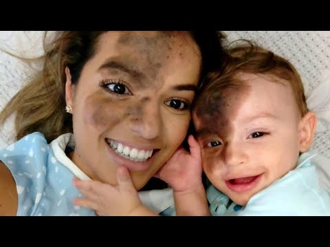 Mom Uses Makeup to Match Son's Facial Birthmark