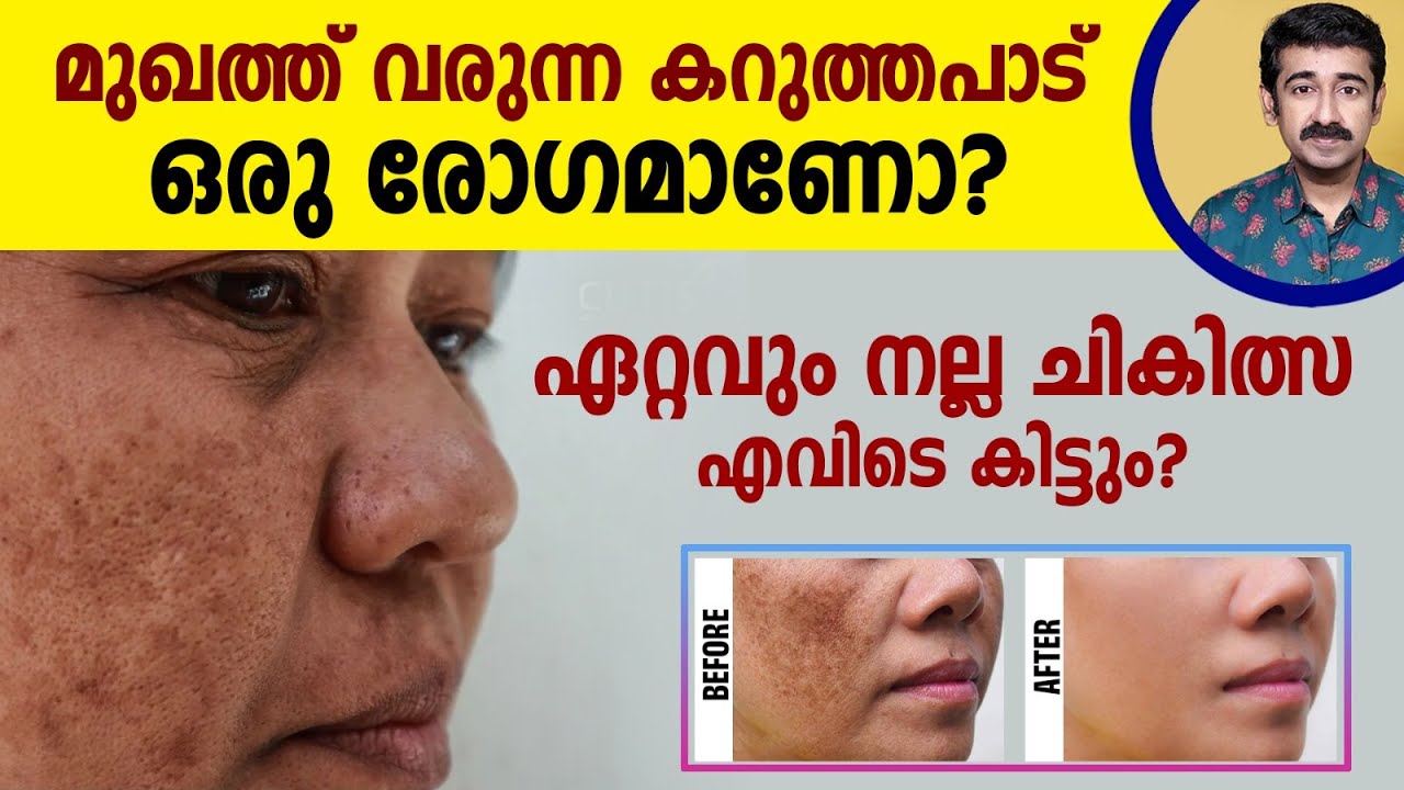 Вот почему на лице появляются тёмные пятна? Это болезнь? Где можно получить качественное лечение?