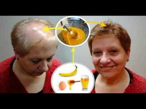 recipe-to-grow-your-hair-leave-all-doctors-with-open-mouth-|-stop-hair-loss-|hair-restoration