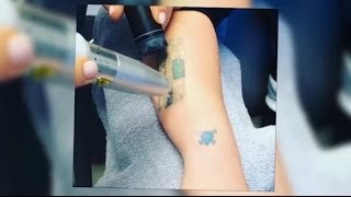 Kelly Osbourne Shares Tattoo Removal Snap Splash News Tv Splash News Tv
