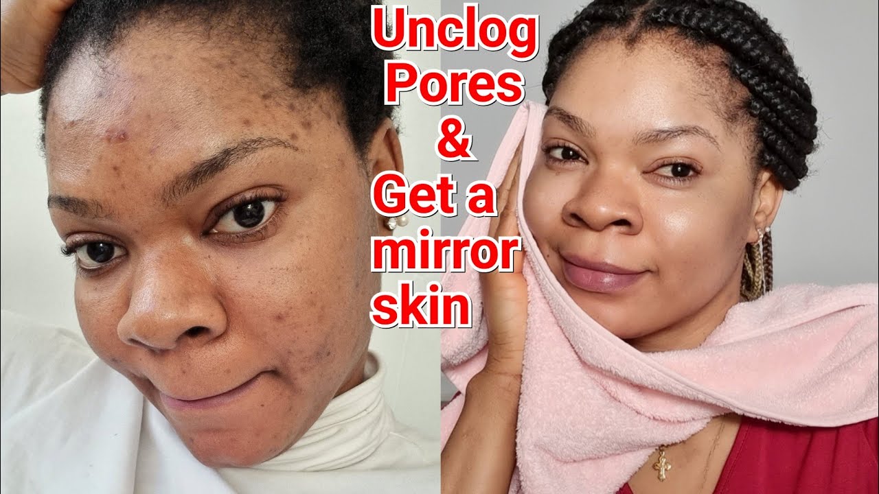what I did that cleared my pimples, acne and dark spots,WORKS MAGIC # ...