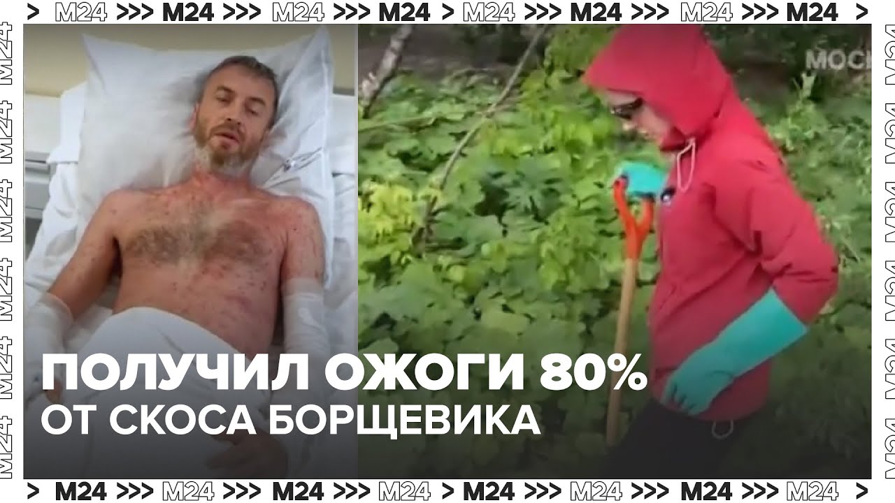 Россиянин получил ожоги 80% тела после того, как скосил борщевик! 🌱🔥