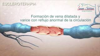 Sherwood parque de escleroterapia