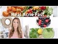 What I Eat To Heal Acne Fast